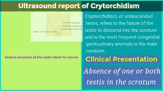 ultrasound report of Cryptorchidism Cryptorchidism pathology ultrasound [upl. by Yevi]