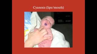 Surgery of Cyanotic CHDs  CRASH Medical Review Series [upl. by Yenduhc]