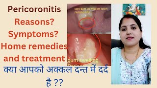 pericoronitisCausesSymptomsHome remedies and treatment [upl. by Goda566]