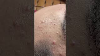 Great Blackhead  Acnetreatment Mai Ngoc [upl. by Engis]