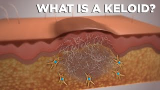 WHAT IS A KELOID [upl. by Molloy]