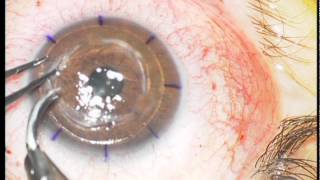 Trapianto cheratoplastica lamellare con microcheratomo  Corneal transplantation with microkeratome [upl. by Lori]