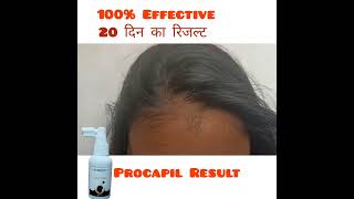 Procapil Results Hair Tonic Review [upl. by Kipper]