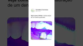 Veja como é feita a restauração em um dente quebrado  DenteBelo [upl. by Aleacim197]