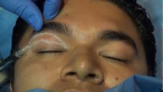 chemical right upper blepharoplasty with endopeel technique [upl. by Meredithe283]