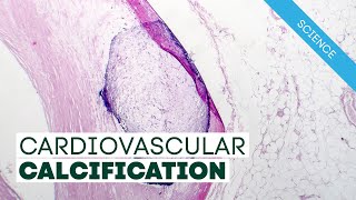 Vitamin K2 and Cardiovascular Calcification [upl. by Eenaej808]