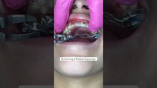 Removal of a palatal expander for orthodontic treatment braces satisfying orthodontist [upl. by Tnecnivleahcim]