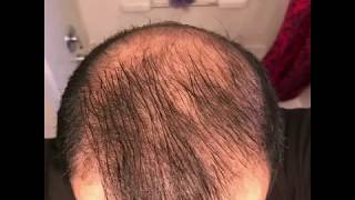 5 months using minoxidil  Rogaine 5 Before amp After results [upl. by Suiravad]