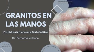 GRANITOS EN LAS MANOS PRURITO Vejiguitas en los dedos DISHIDROSIS O ECCEMA DISHIDRÓTICO 🖐 [upl. by Kirit]