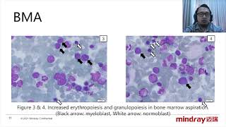 IFCC Clinical Case 4：Transient Abnormal Myelopoiesis Down Syndrome with Thrombocytosis in 24 days ol [upl. by Alius941]