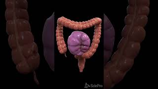 Understanding Colon Volvulus A Twist in the Digestive Tale [upl. by Nylodam]