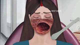 ASMR Animation treatment from infected mouth  2D Animation restasmr1 [upl. by Cammy]