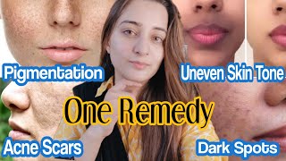 Acne Scar Removal  Pigmentation Treatment on Face  Uneven Skin Tone [upl. by Noseimaj]