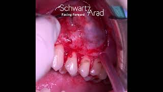 Enucleation of a Glandular Odontogenic Cyst [upl. by Oek]