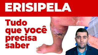 Erispela como curar sinais e sintomas e como prevenir suas complicações Guia completo da doença [upl. by Thurstan]