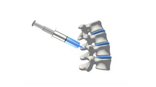 Medial Branch Block [upl. by O'Callaghan]