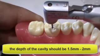 Class I cavity preparation for Mandibular 1st molar [upl. by Ydnal]