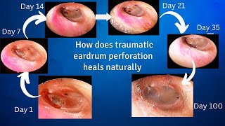 Natural healing of traumatic eardrum perforation  weekly follow up videos [upl. by Gnep]