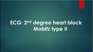 ECG 2nd degree heart block Mobitz type II [upl. by Enyamert29]