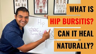 What Is Hip Bursitis Symptoms amp Diagnosis [upl. by Euqilegna]