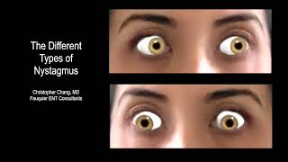 Types of Nystagmus Due to BPPV Vertigo What it Looks Like Which Side amp Which Maneuver [upl. by Yanahc]