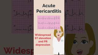 Acute Pericarditis and Myocardial Infarction  PLAB  UKMLA  MedRevisions [upl. by Irvine19]