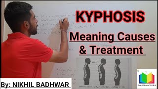 What is Kyphosis Meaning Causes amp Treatment of Kyphosis [upl. by Dugaid]