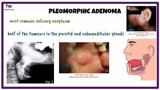 Pleomorphic Adenoma  Oral Medicine [upl. by Soulier]