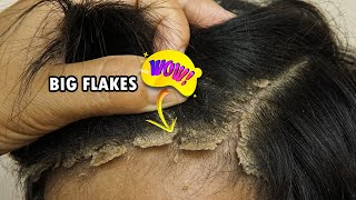 Huge Psoriasis Flakes Scratching Satisfying Dandruff Removal 432 [upl. by Erbes]