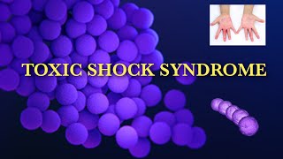 Toxic shock syndrome  TSS  Clindamycin [upl. by Liw659]