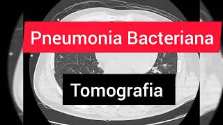 Pneumonia Bacteriana na Tomografia de Torax  TC [upl. by Nylodnew803]