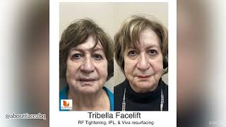 Tribella Facelift at About Face Med Spa [upl. by Fugere64]