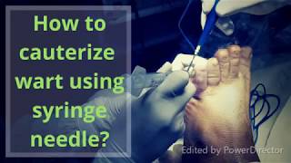 How to remove planter wart using syringe needle [upl. by Aenet]