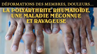 Déformations des membres douleurs…  La polyarthrite rhumatoïde une maladie méconnue et ravageuse [upl. by Wilbur]