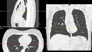 Tomografía de Tórax Algunos aspectos básicos en el abordaje de pacientes con patología torácica [upl. by Donelson]