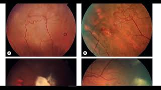 Kanski clinical Ophthalmology Made Easy  Retina 6 [upl. by Dalenna206]