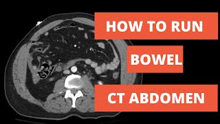 How to read a CT  Approach to Running Bowel [upl. by Aluap]