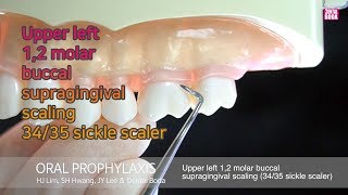 Upper left 12 molar buccal supragingival scaling 3435 sickle scaler [upl. by Dickens786]