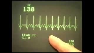 EKC ECG rhythms 1 Normal range of rhythms [upl. by Robertson301]