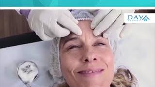 ACUPUNTURA ESTÉTICA FACIAL Y CORPORAL MICRONEEDLING [upl. by Rici520]