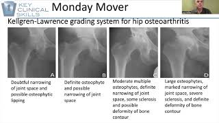 Radiological Hip OA [upl. by Eelik887]