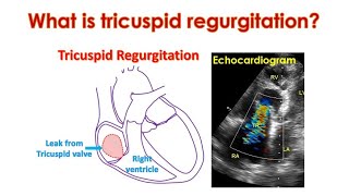 What is Tricuspid Regurgitation TR [upl. by Goldfarb]