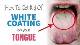 How To Get Rid of Coated Tongue at Home  Home Remedies for White Coated Tongue [upl. by Cazzie]