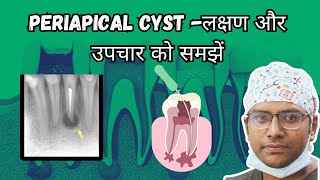 Dr Rudra Mohan  लक्षण और उपचार को समझें PERIAPICAL  RADICULAR CYST Daant ke infection se Swelling [upl. by Ayimat605]