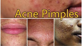 Acne pimples by dermatologist Dr Suman Agarwal [upl. by Parker]