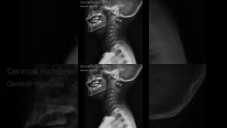 The xray of the cervical lateral اشعة جانبية للفقرات العنقية الرقبه [upl. by Anitselec]