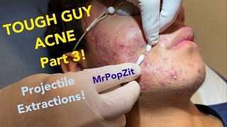 Tough Guy Acne part 3 Projectile extractions very poppy Follow his progresslinks in description [upl. by Airdnal862]