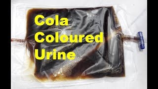 Cola Coloured Urine [upl. by Buford]