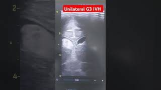 Cranial ultrasound in preterm neonate shows intraventricular hemorrhage G3 neonates hemorrhagic [upl. by Ijnek]