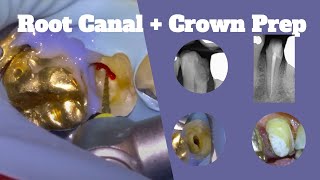 116 Live Root Canal  Crown Prep [upl. by Sisi379]